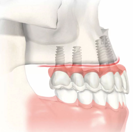 advanced_implant_img_1