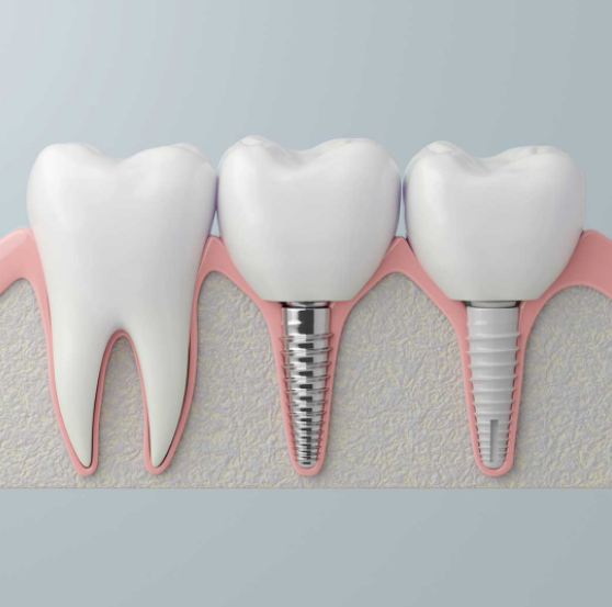 advanced_implant_img_2