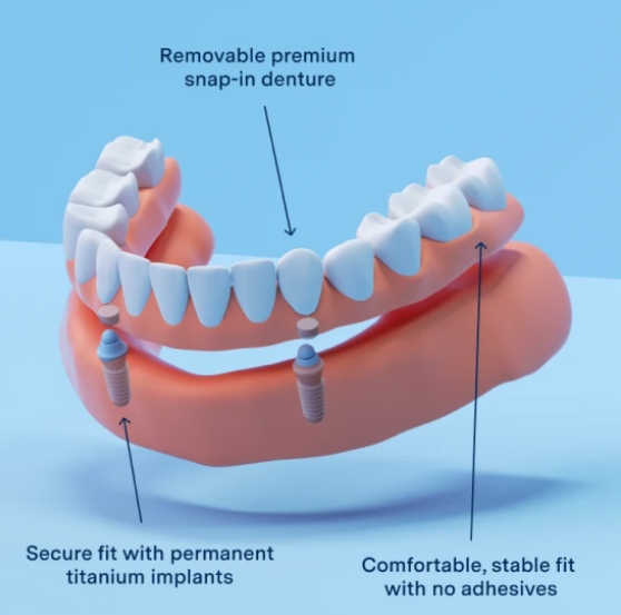 advanced_implant_img_3