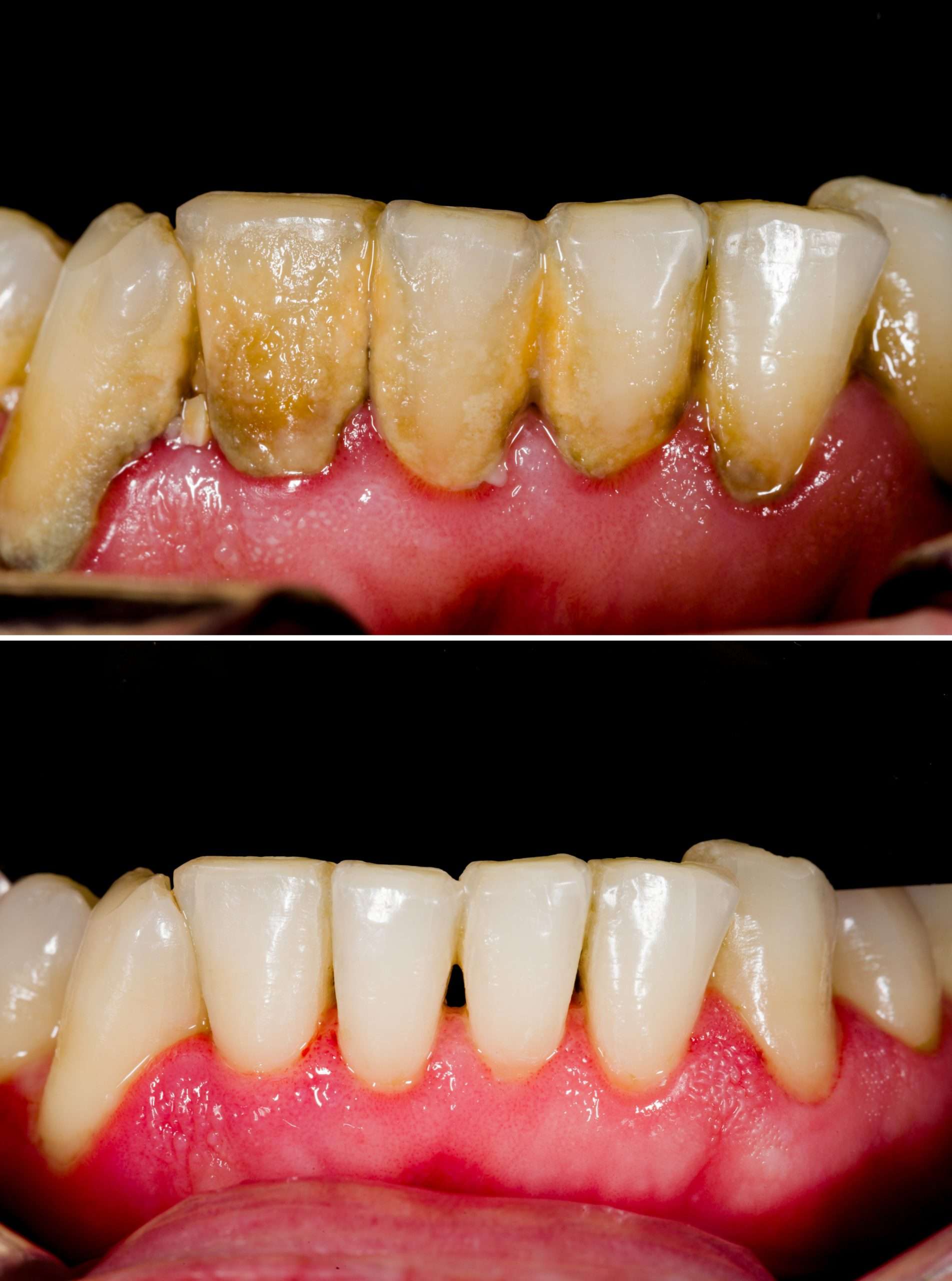 teeth whitening 2