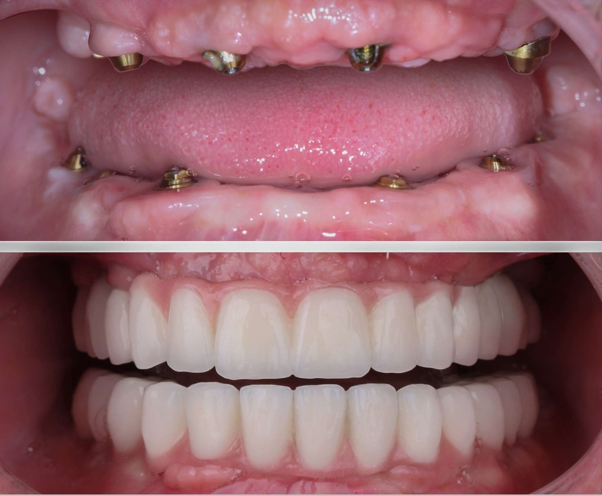 teeth whitening 2