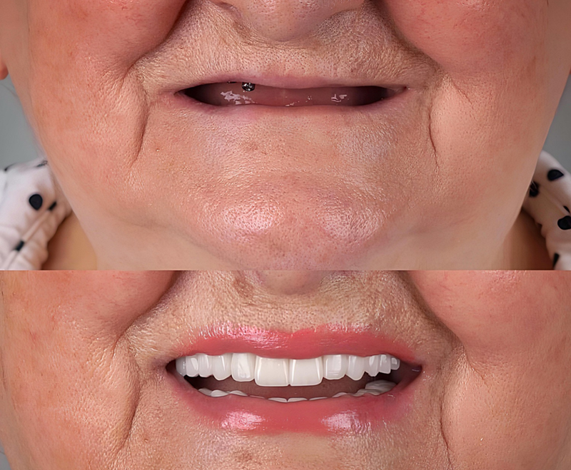 teeth whitening 2