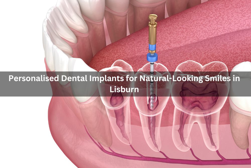 Personalised Dental Implants for Natural-Looking Smiles in Lisburn