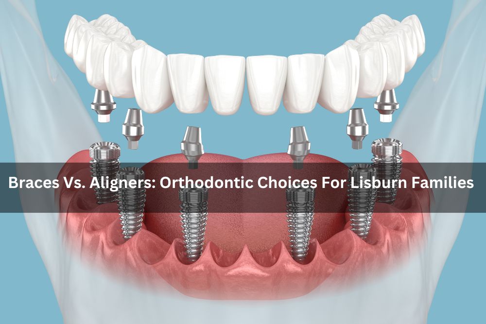 Braces Vs. Aligners: Orthodontic Choices For Lisburn Families